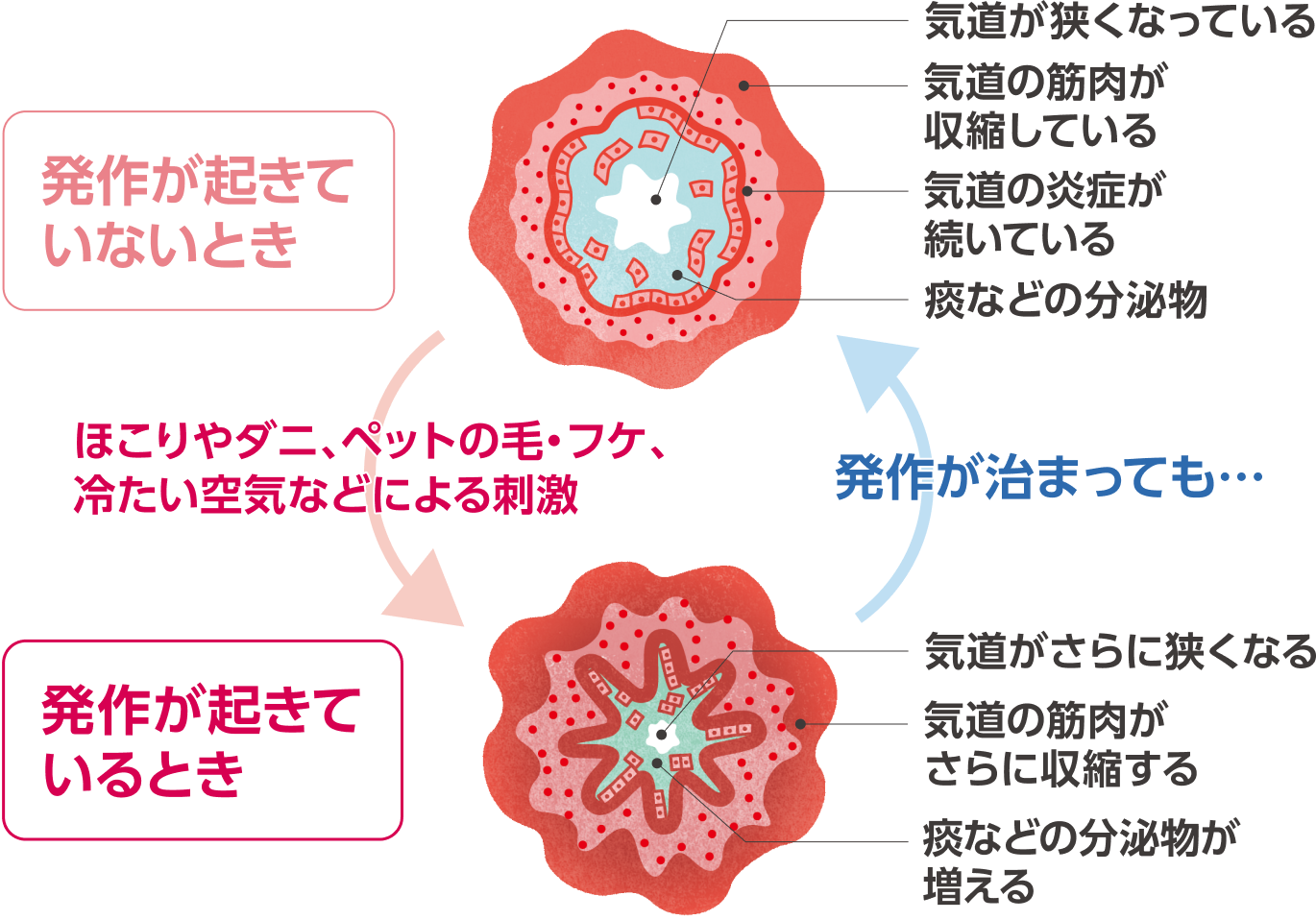 ぜん息患者さんの気道
