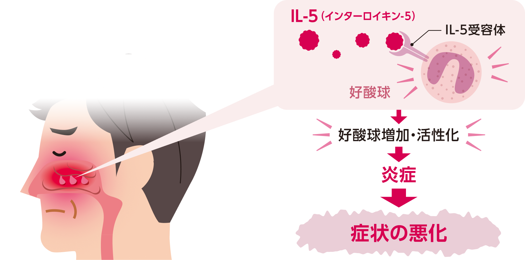 IL-5が好酸球に結合し、好酸球の増加・活性化を促すことで、炎症を引き起こし鼻の症状を悪化させます